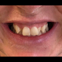 Adult Braces 1 before